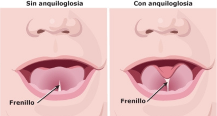 Imagen de anquiloglosia y sin anquiloglosia