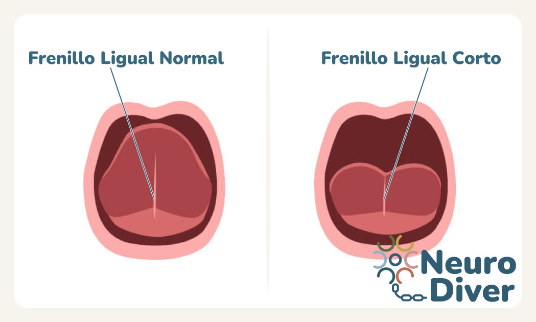 Imagen frenillo lingual alterado o anquiloglosia Neuro Diver Granada